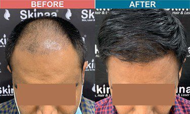 hair-transplant-treatment-at-skinaa-clinic-case-6