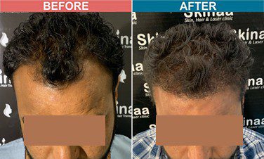 hair-transplant-treatment-at-skinaa-clinic-case-8