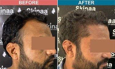 hair-transplant-treatment-at-skinaa-clinic-case-9