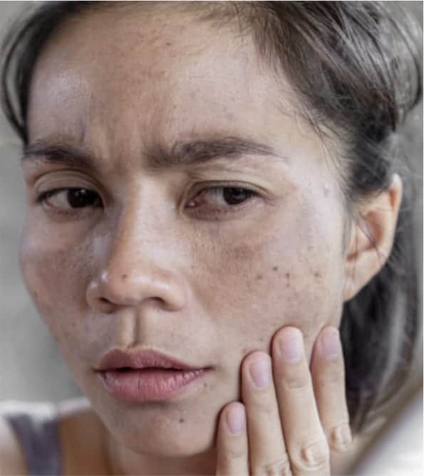 melasma-and-pigmentation-1