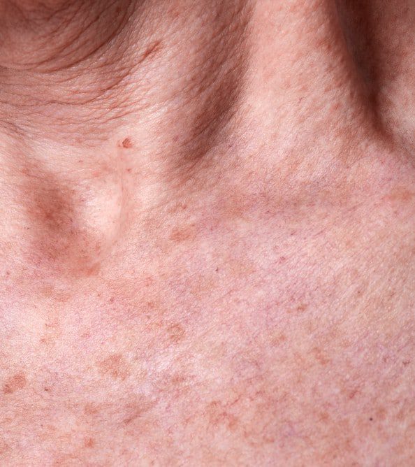 Melasma - Know About Disease, Treatments, & Cost | skinaa Clinic, Jaipur