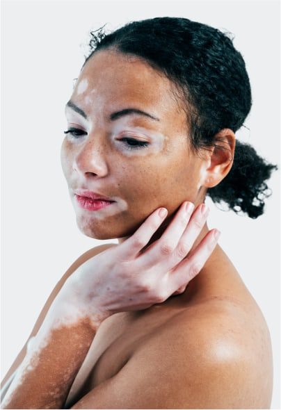 Vitiligo Treatment in Jaipur Micropigmentation for Vitiligo in