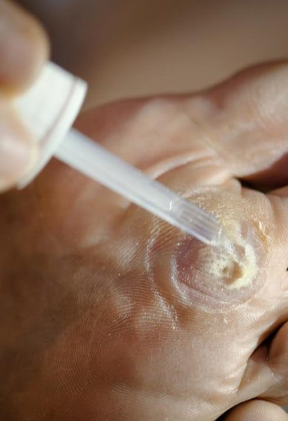 pulling out plantar wart root