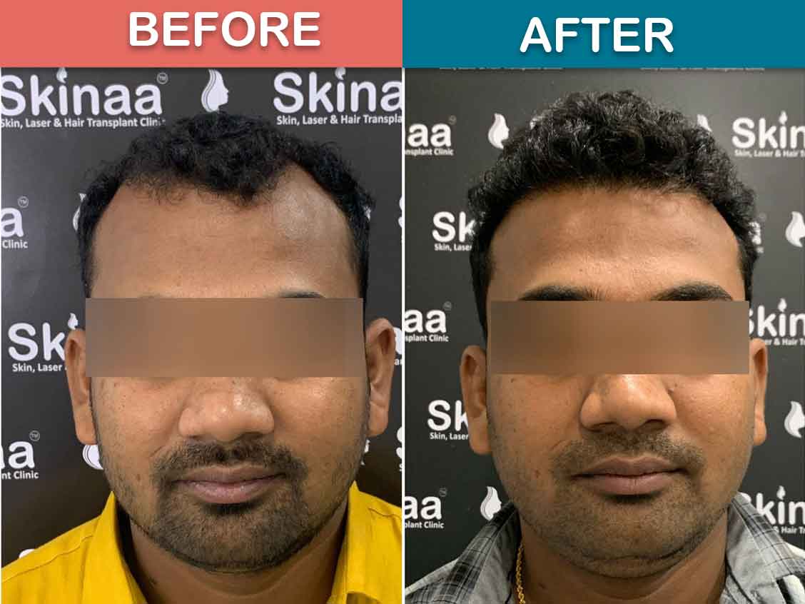 Happy Clients | Regrow Hair Transplant Clinic, Haridwar