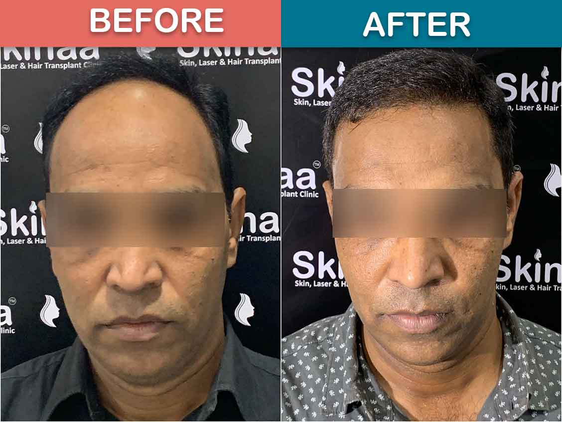 Hair transplant Result | QHT Hair Transplant || Before & After || Regrow  Clinic Haridwar - YouTube
