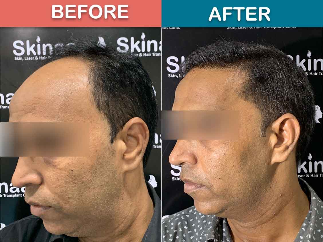 Hair Transplant Before After | Some Of Our Favorite Results From 2019!