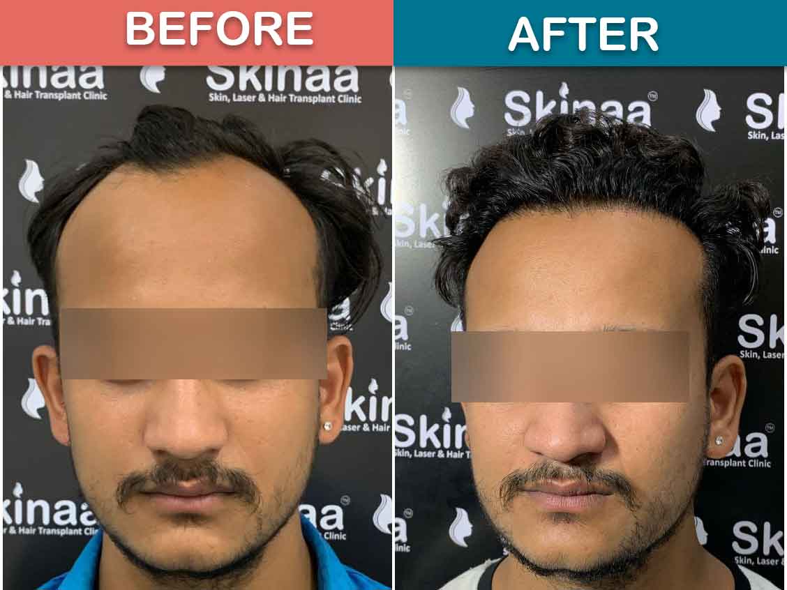 Redness After Hair Transplant: How To Reduce Redness And How Long It Lasts