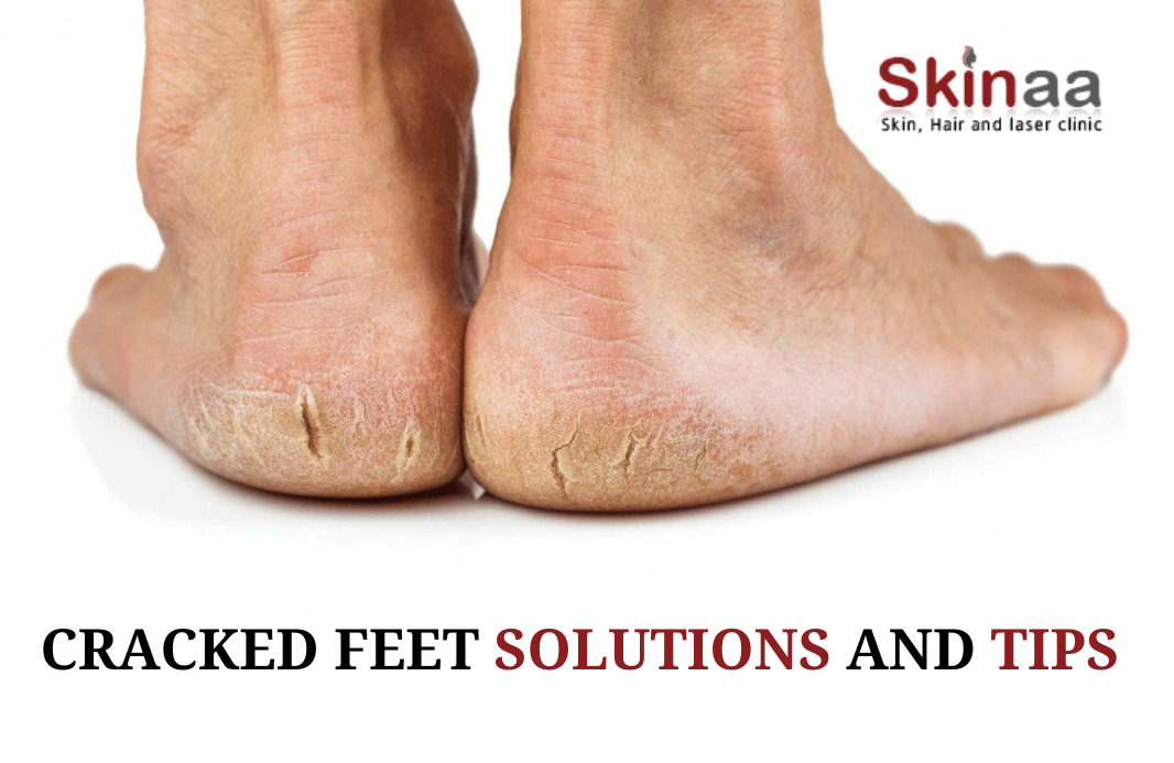 Cracked skin on feet and hands - causes & treatment | Eucerin