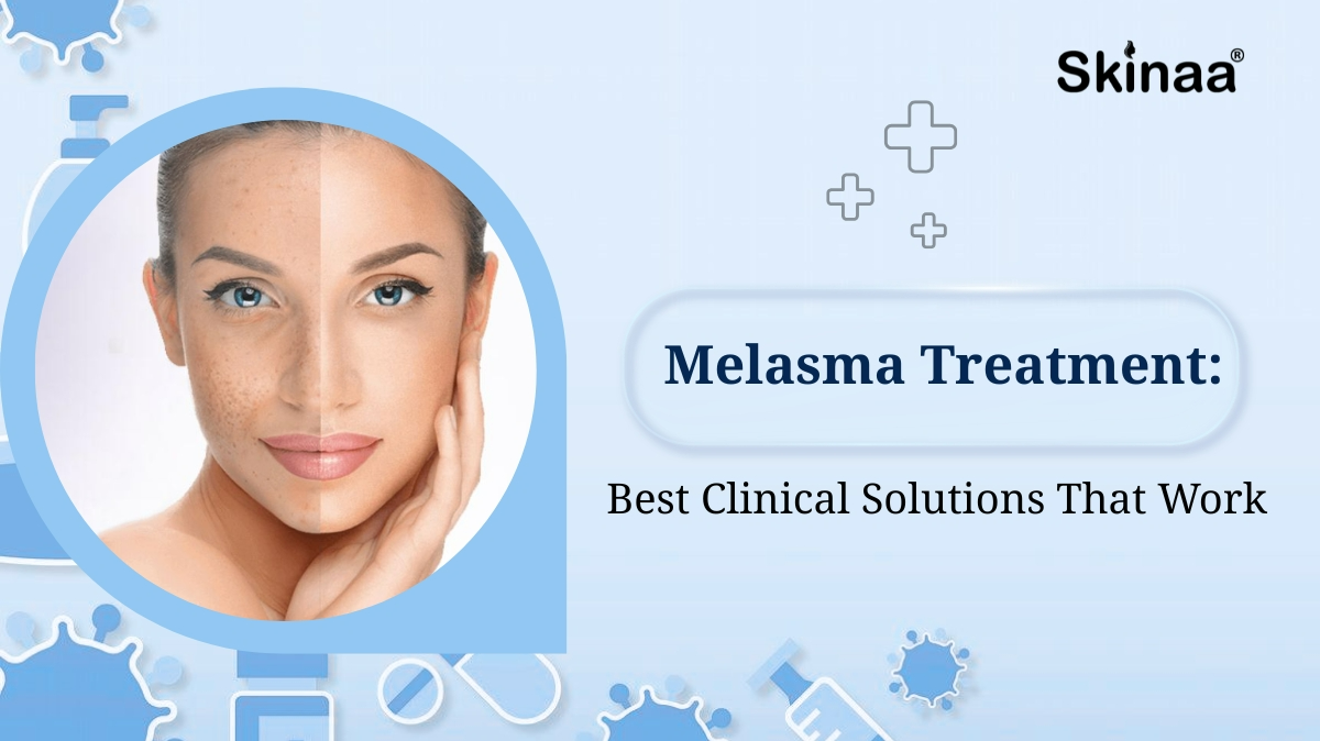 melasma treatment