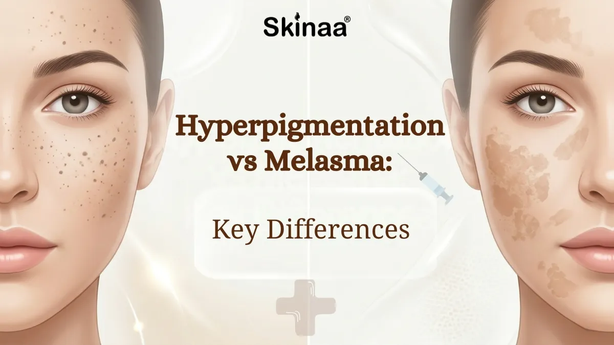 hyperpigmentation vs melasma