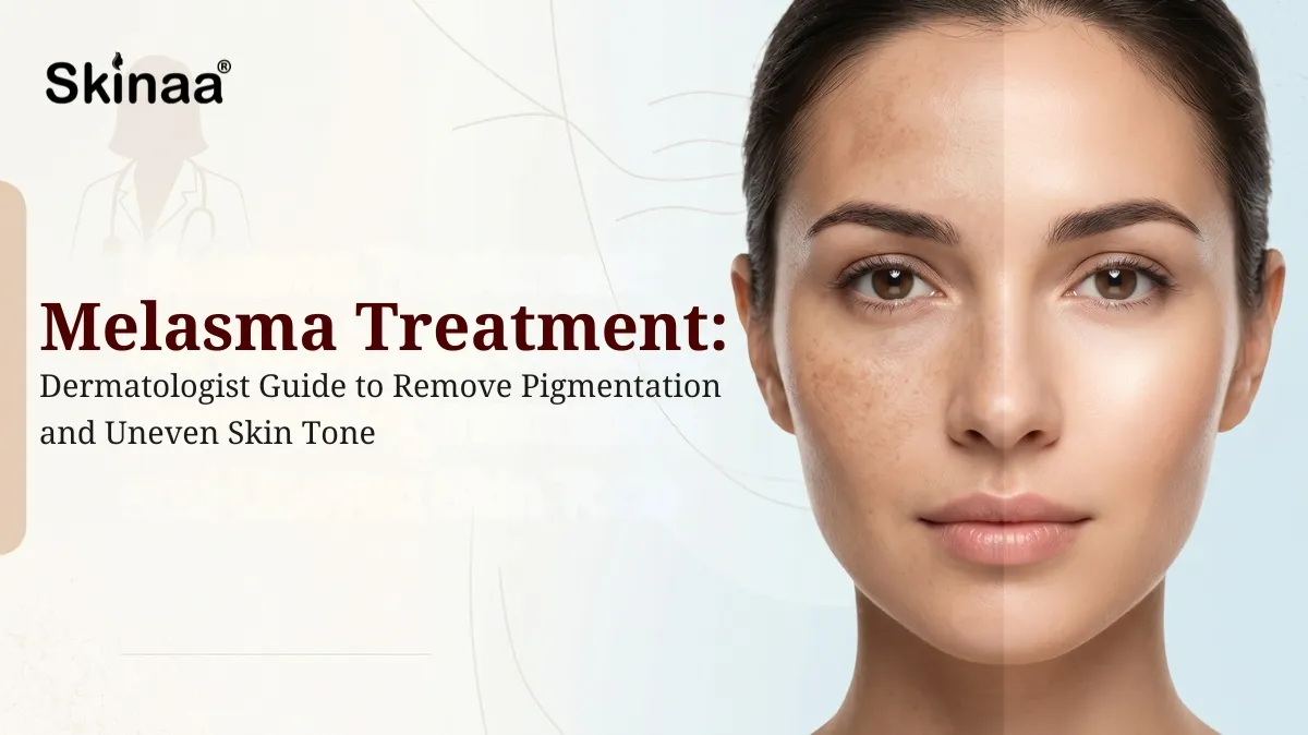 melasma treatment