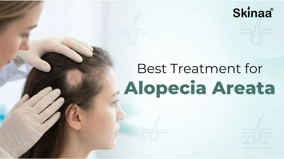 best treatment for Alopecia Areata