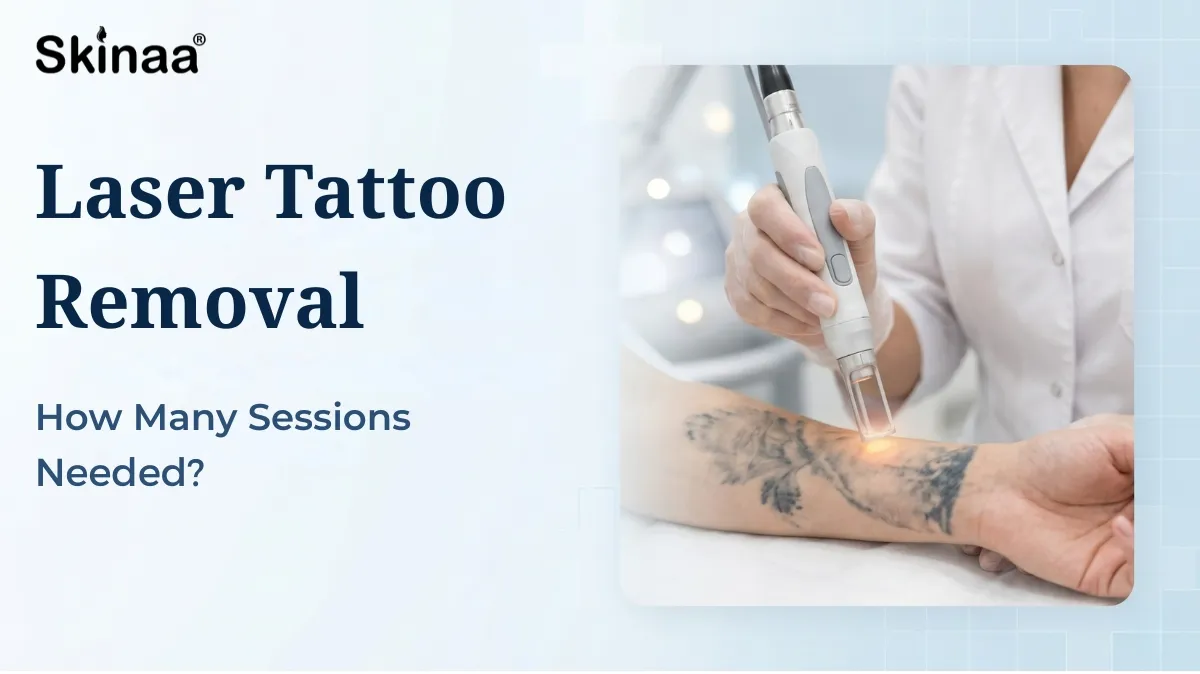 laser tattoo removal