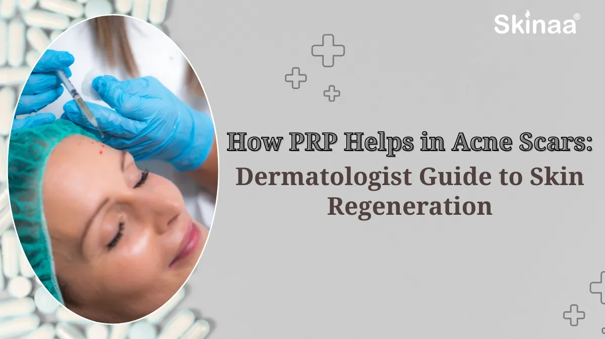 prp for acne scars