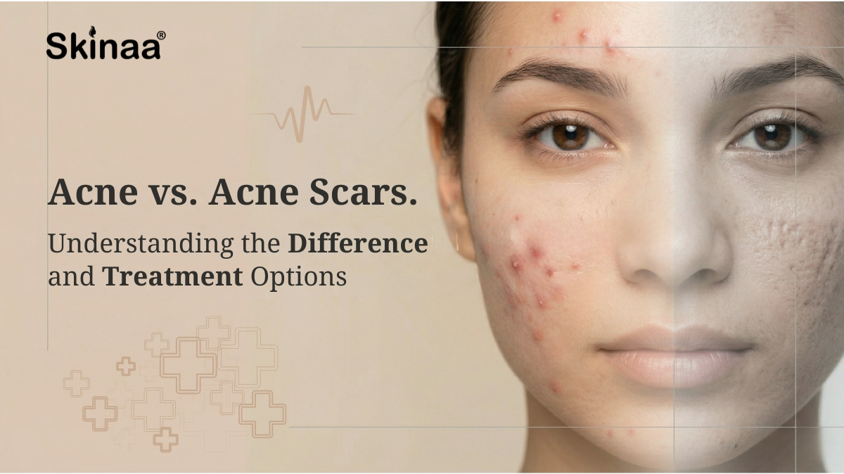 acne vs acne scars