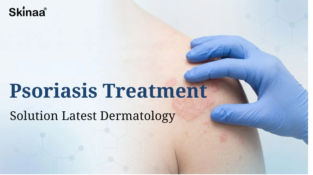 Psoriasis treatment