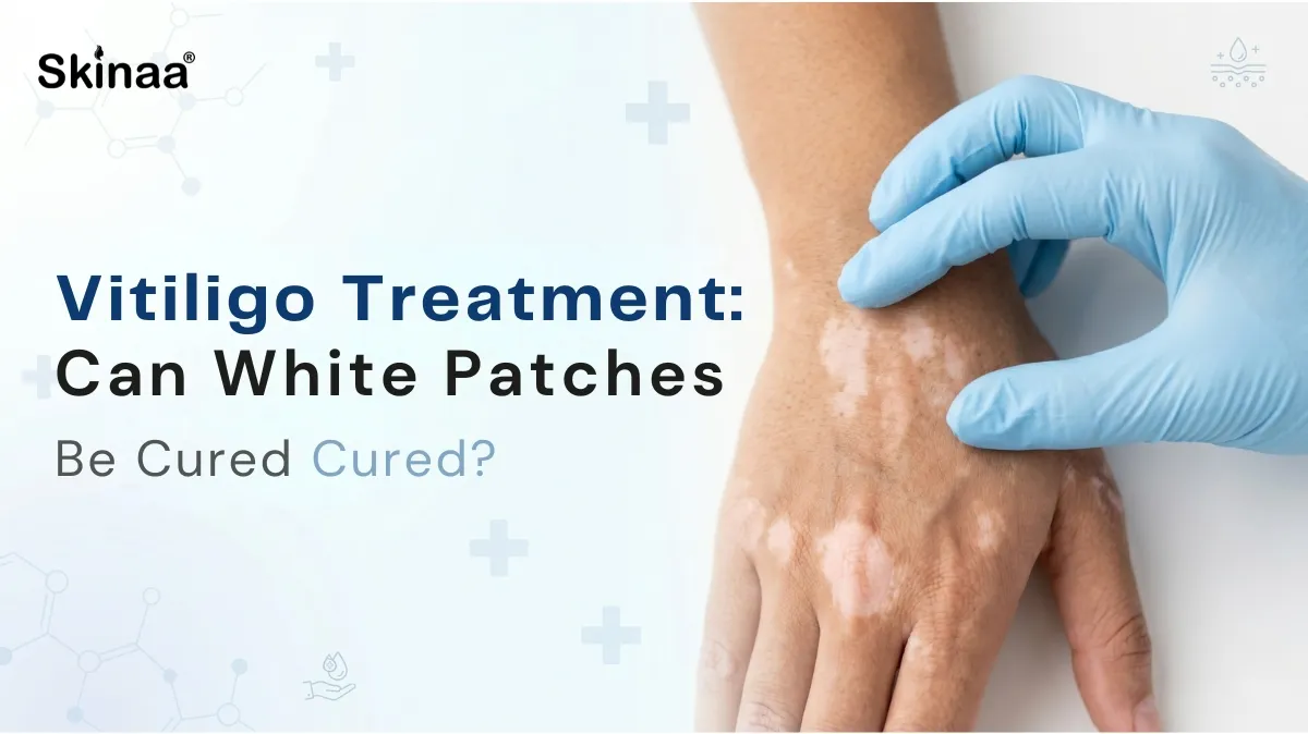 Vitiligo treatment